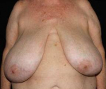 Breast Reduction - Case #5 Before